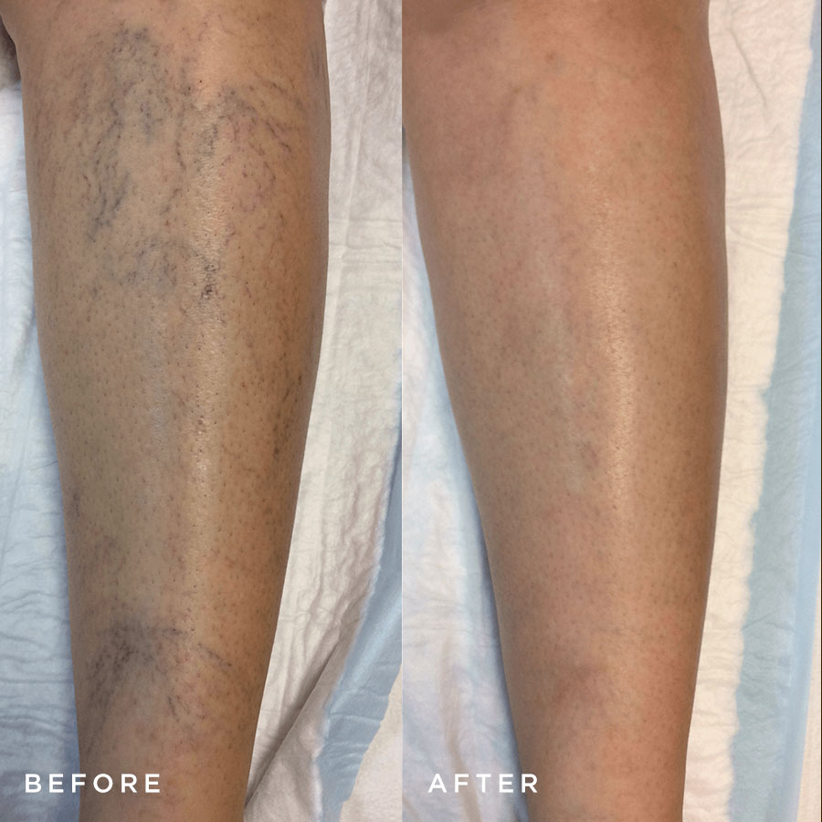 sclerotherapy-before-after1