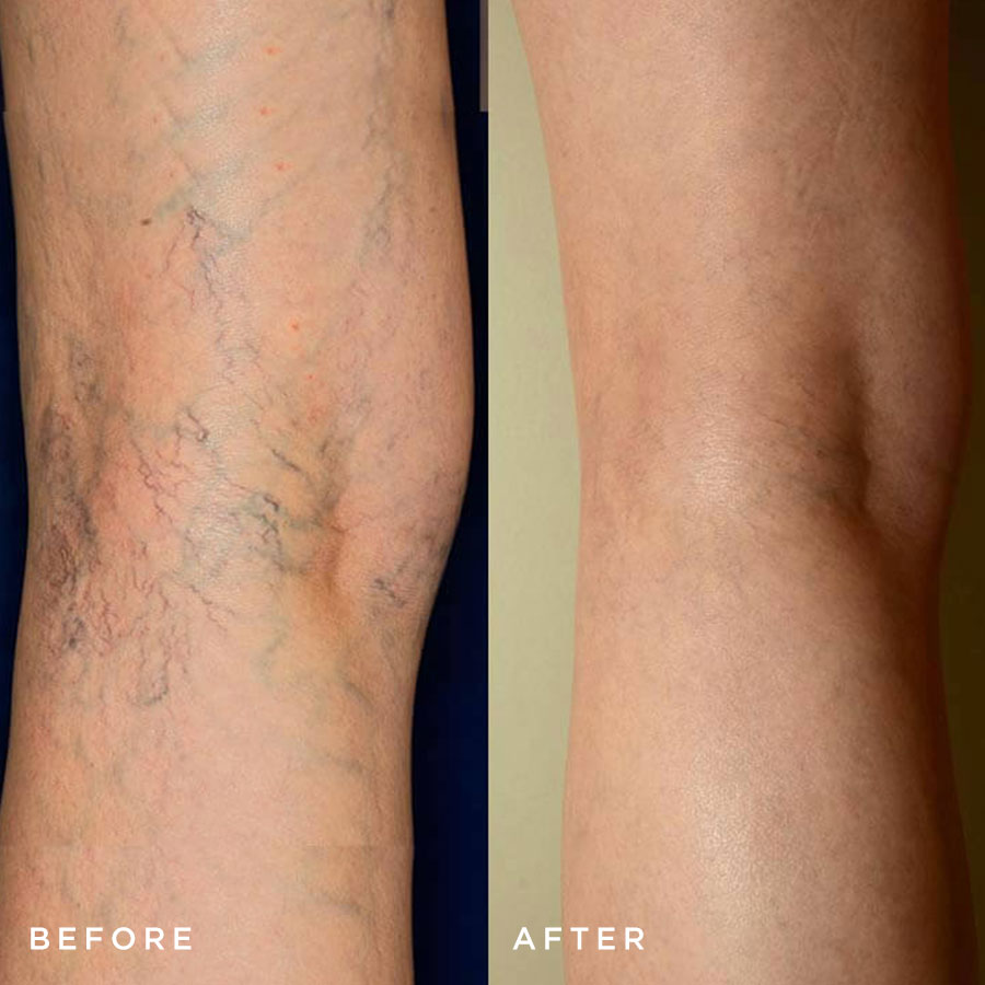 sclerotherapy-before-after2